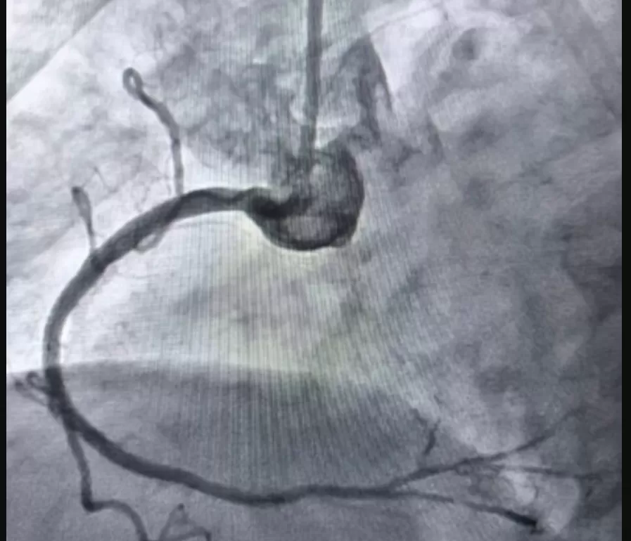 У Тернополі вперше провели унікальну операцію на серці